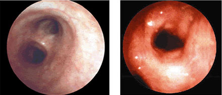 two images of airway as seen during bronchoscopy, one normal and the other narrowed due to inflamation