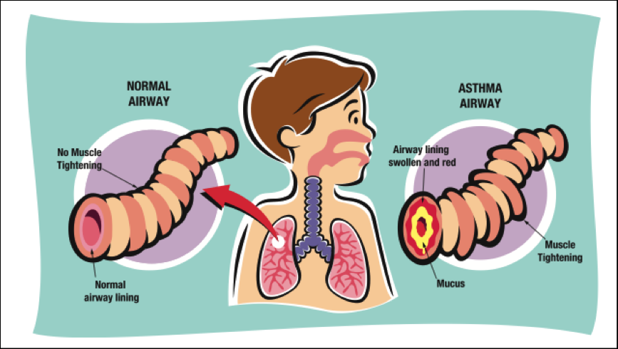 normal airways have no muscle tightening are open.  Asthma airways are swollen and filled with mucus and are much smaller.